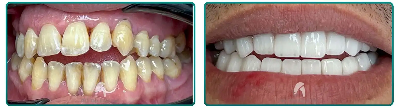 Natural Looking Crowns