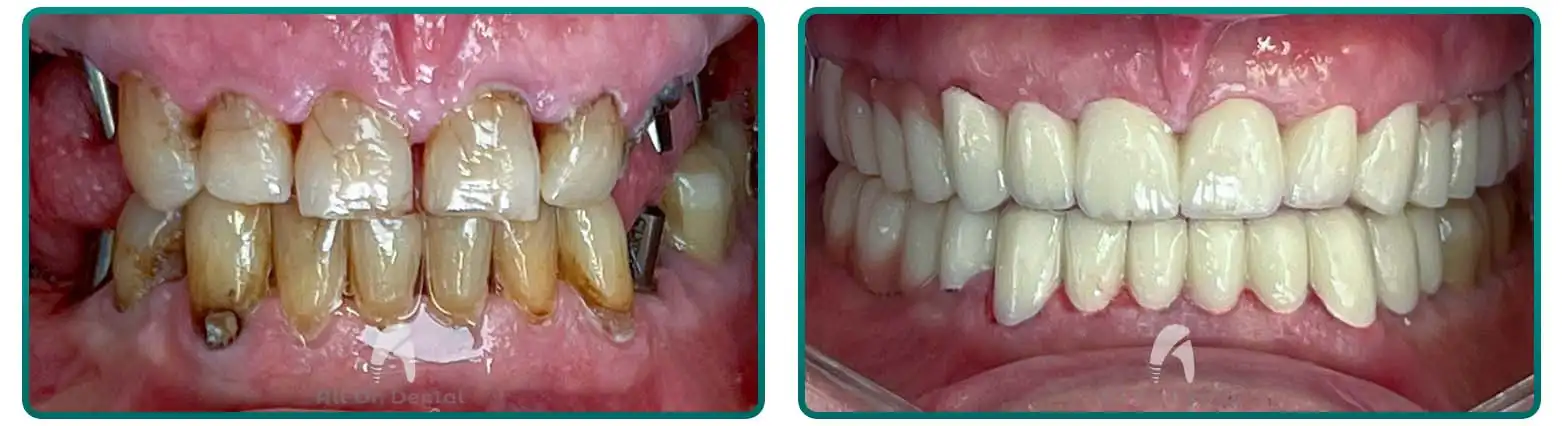Dental Implant Timeline