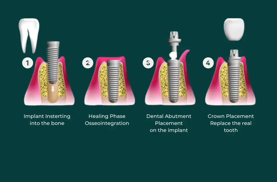 Dental Implant Worth