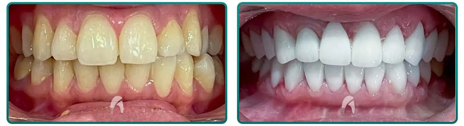 Veneers Case