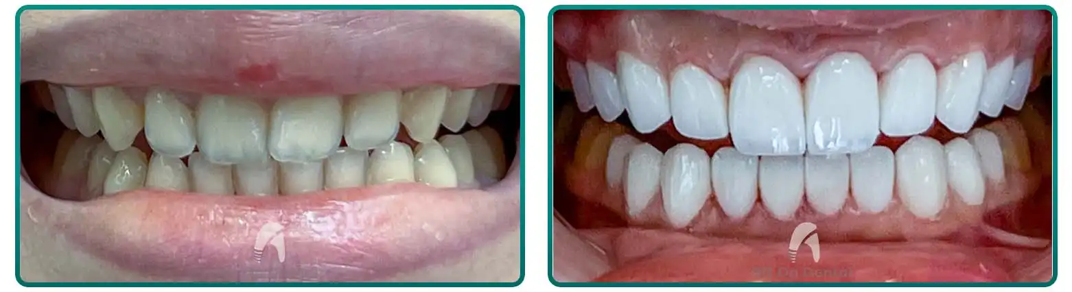 All You Need To Know About Dental Veneers In Turkey