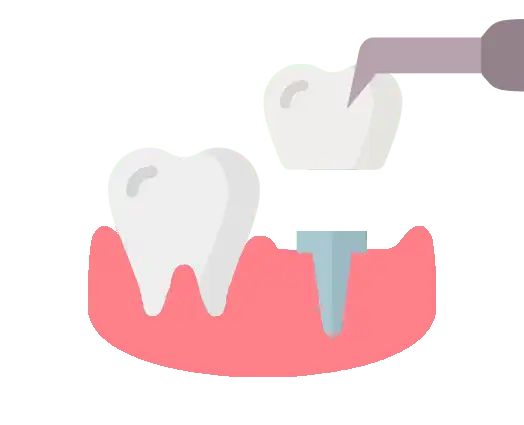 Temporary Prothesis