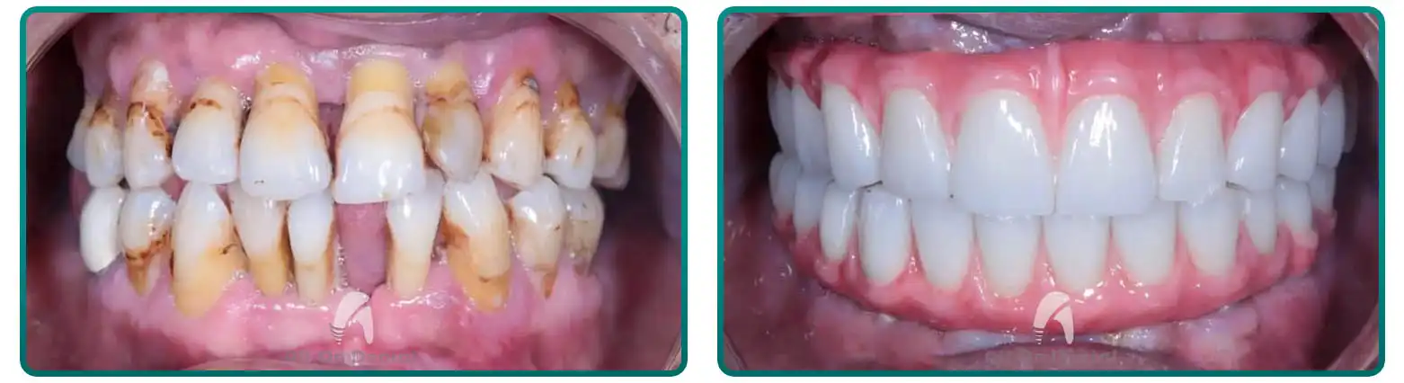 3-On-6 Posterior Restoration