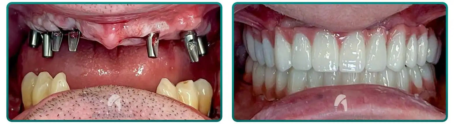 All-On-4 Before After Case 2