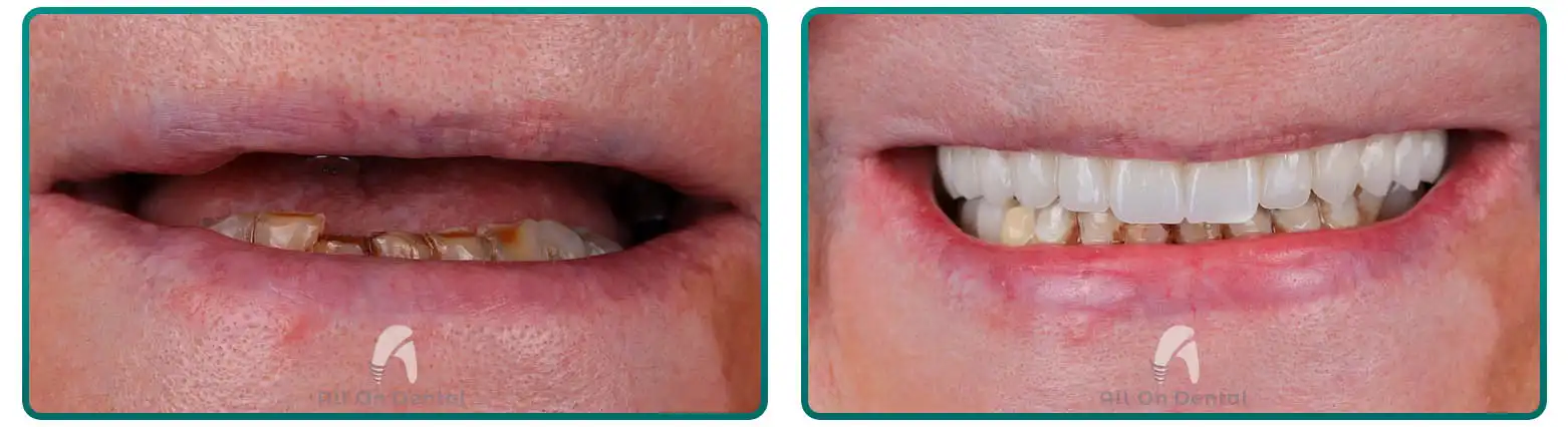 All-On-4 Lower Jaw Reconstruction