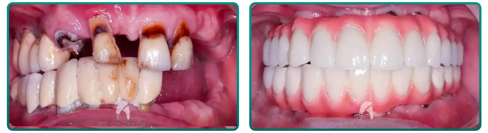 All-On-4 Smile Transformation