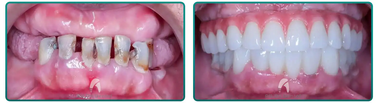 All-On-6 Full Mouth Restoration