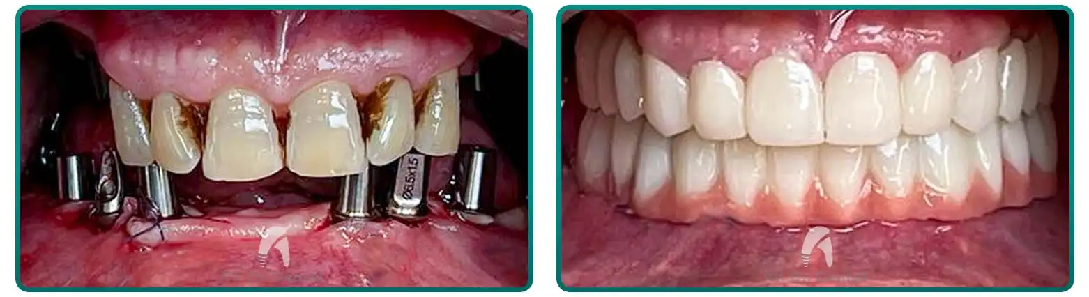 Dental Implant Case 6