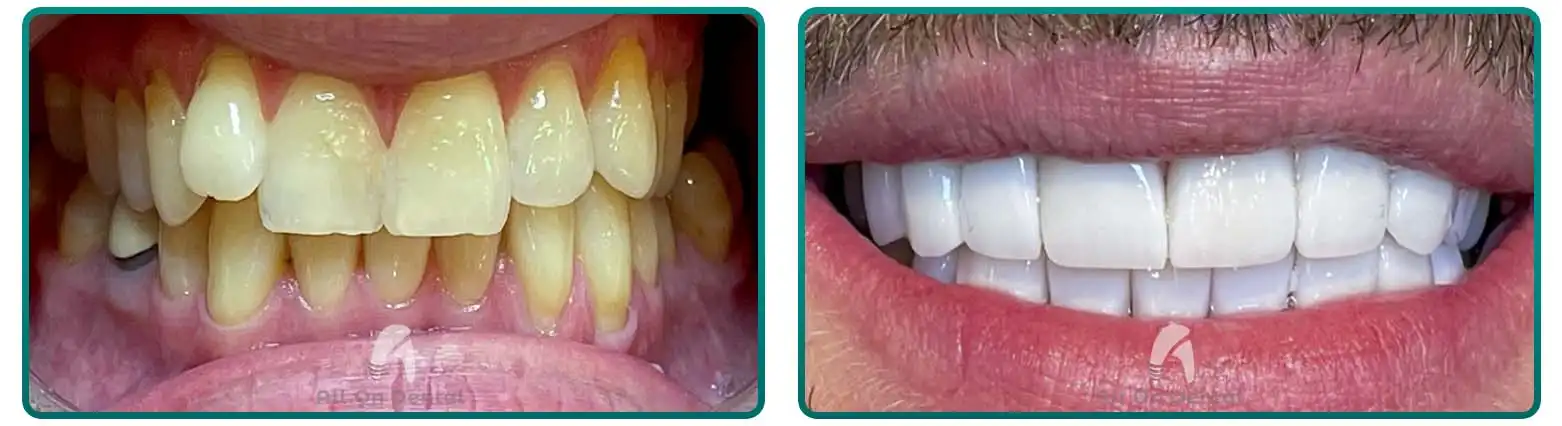 Dental Bridge Before After Case 4