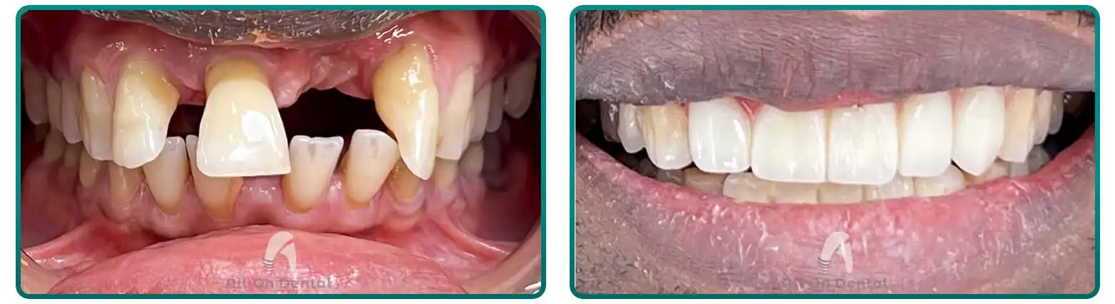 Dental Bridge Before After Case 8