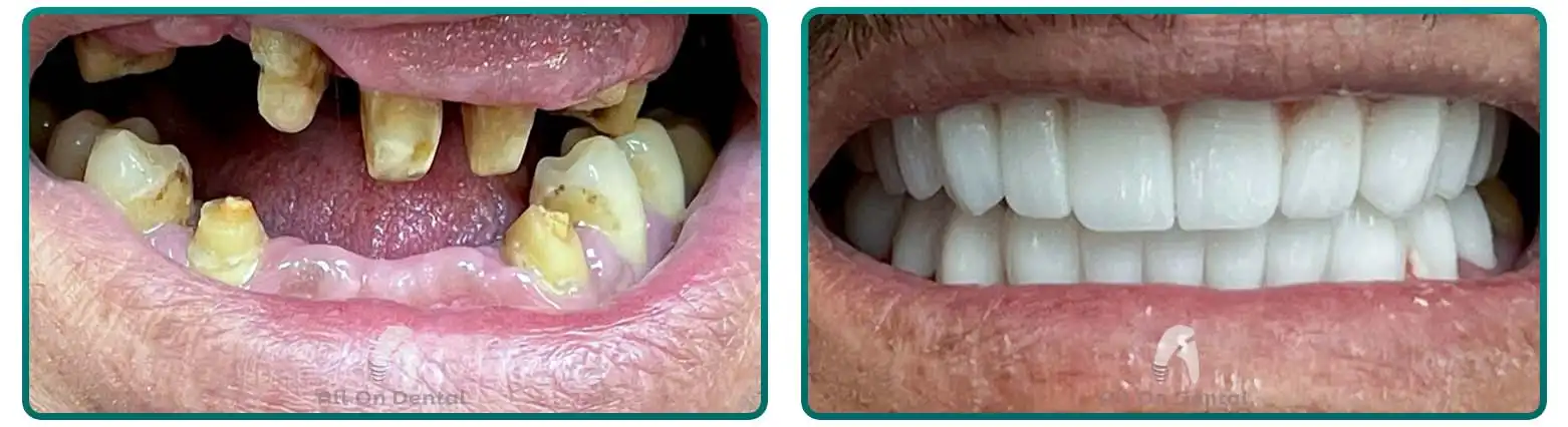 Full Mouth Bridge Work