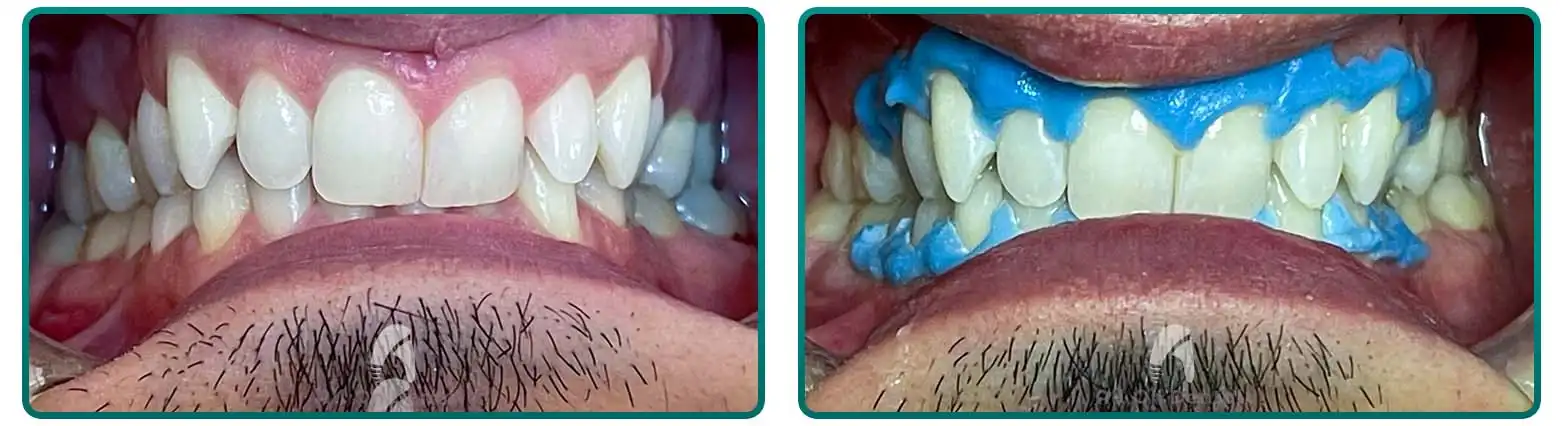 Professional Teeth Whitening
