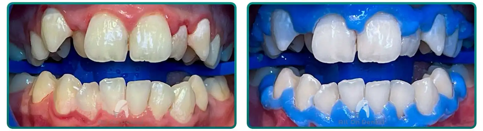 Laser Teeth Whitening