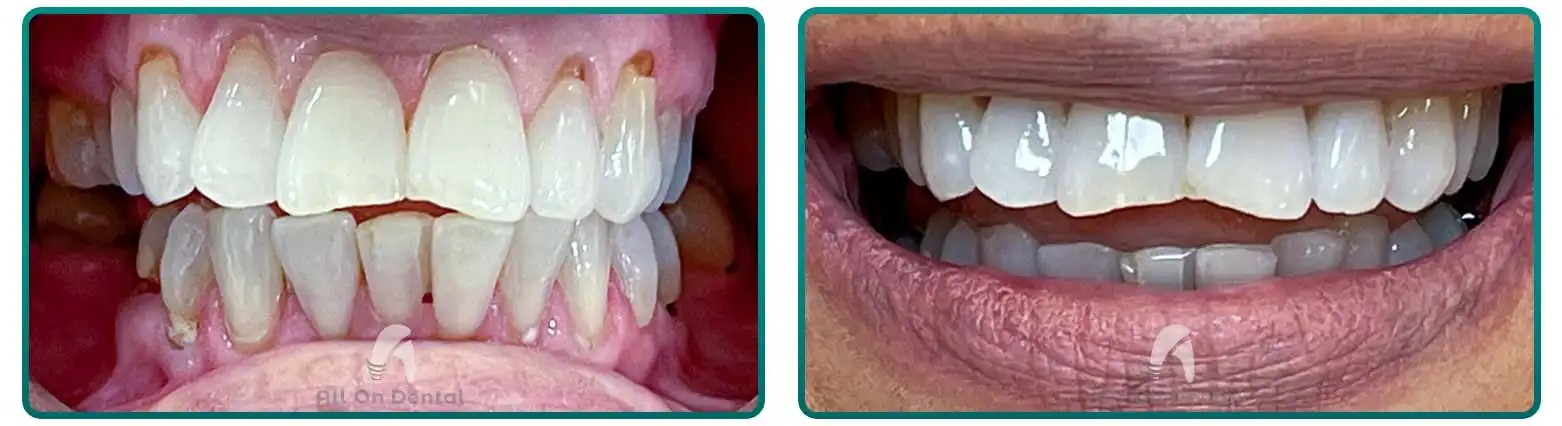 Teeth Whitening Before After Case 4