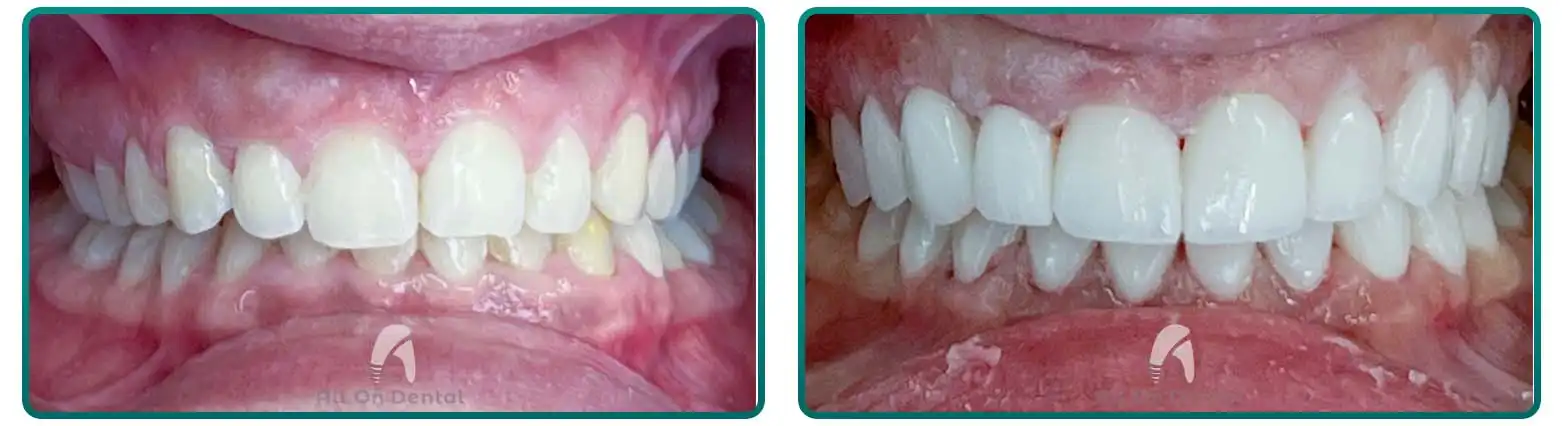 Veneers for Discolored Teeth