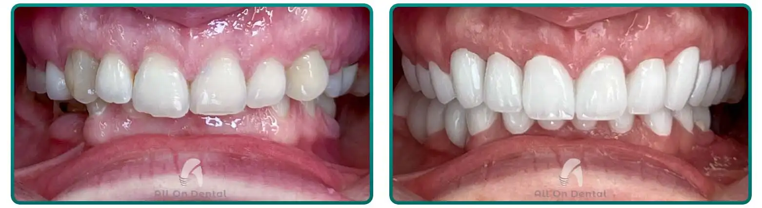 Smile Design with Veneers