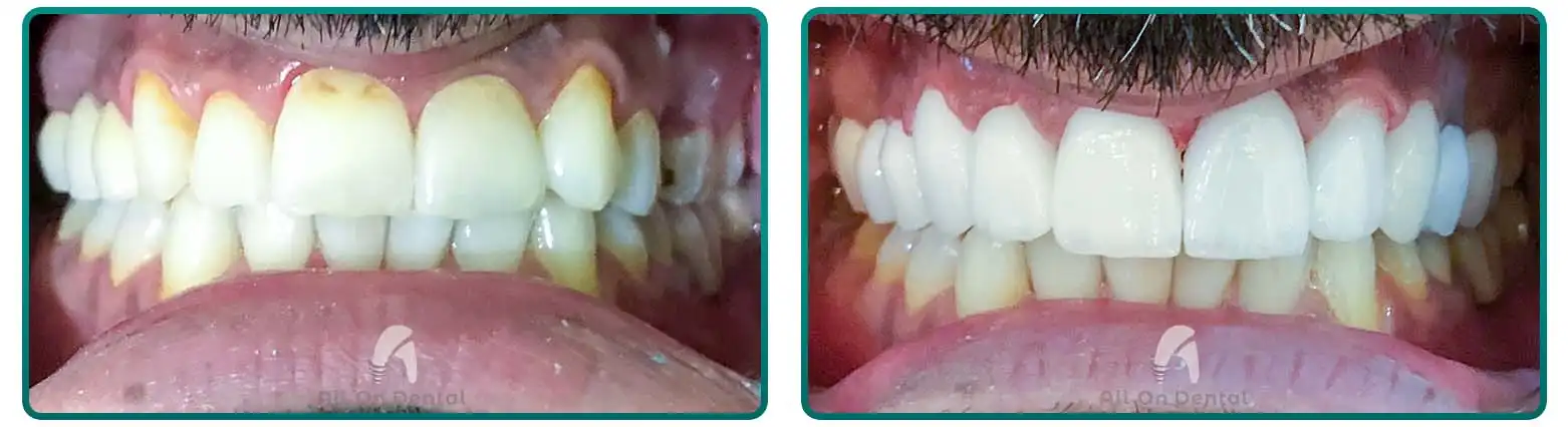 Veneers for Gap Teeth